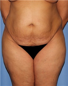 Tummy Tuck Before Photo by Siamak Agha, MD PhD FACS; ,  - Case 46774