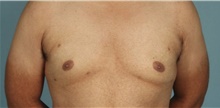 Male Breast Reduction After Photo by Keyian Paydar, MD, FACS; Newport Beach, CA - Case 46868