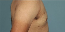 Male Breast Reduction After Photo by Keyian Paydar, MD, FACS; Newport Beach, CA - Case 46868