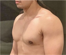 Male Breast Reduction After Photo by Keyian Paydar, MD, FACS; Newport Beach, CA - Case 46877