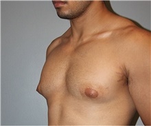 Male Breast Reduction Before Photo by Keyian Paydar, MD, FACS; Newport Beach, CA - Case 46877