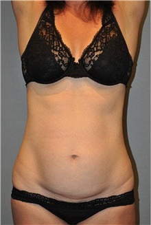 Tummy Tuck Before Photo by Keyian Paydar, MD, FACS; Newport Beach, CA - Case 46901