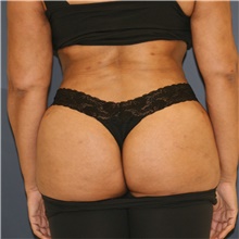 Liposuction After Photo by Steve Laverson, MD, FACS; Rancho Santa Fe, CA - Case 47098