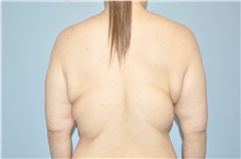 Body Lift Before Photo by Keyian Paydar, MD, FACS; Newport Beach, CA - Case 47130