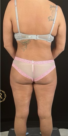 Body Lift After Photo by Babis Rammos, MD, FACS; Peoria, IL - Case 47144