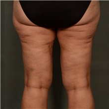 Liposuction After Photo by Ellen Janetzke, MD; ,  - Case 47218