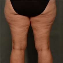 Liposuction Before Photo by Ellen Janetzke, MD; ,  - Case 47218