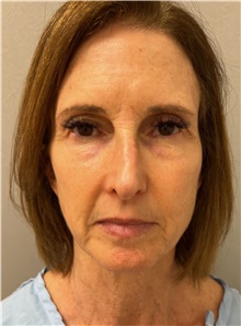Facelift Before Photo by Franklin Richards, MD; ,  - Case 47485