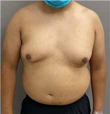 Male Breast Reduction Before Photo by Keshav Magge, MD; Bethesda, MD - Case 47598