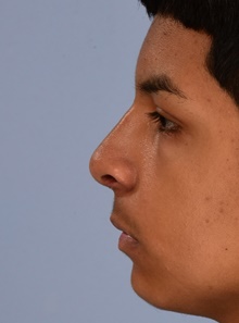 Rhinoplasty After Photo by Christopher Derderian, MD; ,  - Case 47664