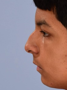 Rhinoplasty Before Photo by Christopher Derderian, MD; ,  - Case 47664