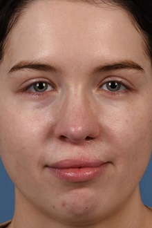 Rhinoplasty After Photo by Christopher Derderian, MD; ,  - Case 47674