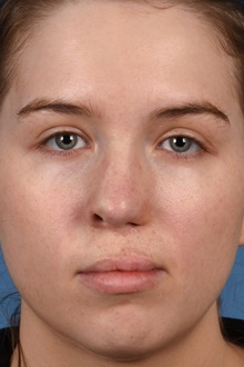 Rhinoplasty Before Photo by Christopher Derderian, MD; ,  - Case 47674