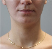 Liposuction Before Photo by Ellen Mahony, MD; Westport, CT - Case 47754