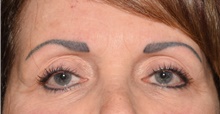Eyelid Surgery After Photo by Derek Cody, MD, FACS; ,  - Case 47811