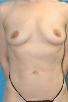 Breast Implant Removal After Photo by Scott Sattler, MD,  FACS; Seattle, WA - Case 47826