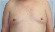 Liposuction Before Photo by Caleb Steffen, MD; Jefferson City, MO - Case 47864
