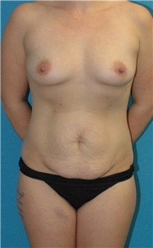 Mommy Makeover Before Photo by Scott Sattler, MD,  FACS; Seattle, WA - Case 47893