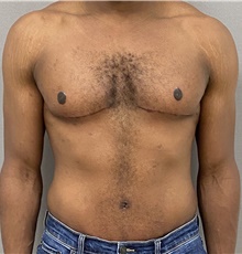 Male Breast Reduction After Photo by Keshav Magge, MD; Bethesda, MD - Case 48018