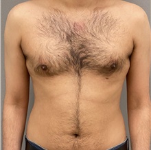 Male Breast Reduction After Photo by Keshav Magge, MD; Bethesda, MD - Case 48068