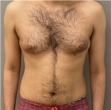 Male Breast Reduction Before Photo by Keshav Magge, MD; Bethesda, MD - Case 48068