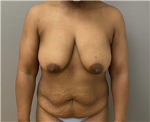 Tummy Tuck Before Photo by Keshav Magge, MD; Bethesda, MD - Case 48128