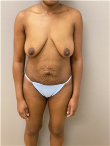 Tummy Tuck Before Photo by Keshav Magge, MD; Bethesda, MD - Case 48215