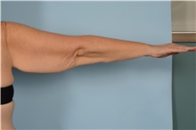 Arm Lift Before Photo by Ellen Janetzke, MD; ,  - Case 48352