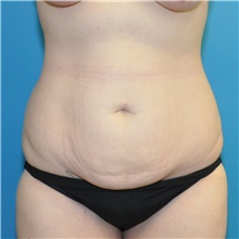 Tummy Tuck Before Photo by Joshua Cooper, MD; Seattle, WA - Case 48375