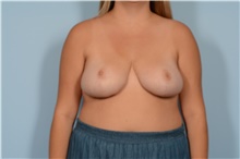 Breast Reduction After Photo by Ellen Janetzke, MD; ,  - Case 48502