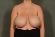 Breast Reduction Before Photo by Ellen Janetzke, MD; ,  - Case 48502