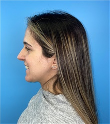Rhinoplasty Before Photo by Mark Markarian, MD, MSPH, FACS; Wellesley, MA - Case 48518