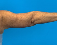Arm Lift After Photo by Eric Wright, MD; Little Rock, AR - Case 48575