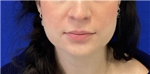Botulinum Toxin Before Photo by Munique Maia, MD; ,  - Case 48753