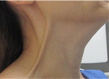 Botulinum Toxin After Photo by Munique Maia, MD; ,  - Case 48757