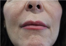 Lip Augmentation/Enhancement Before Photo by Ellen Mahony, MD; Westport, CT - Case 48760