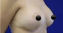 Breast Augmentation After Photo by Munique Maia, MD; ,  - Case 48972