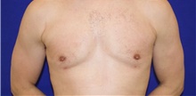 Male Breast Reduction After Photo by Munique Maia, MD; ,  - Case 48992