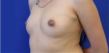 Breast Reconstruction After Photo by Munique Maia, MD; ,  - Case 48993