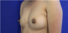 Breast Reconstruction Before Photo by Munique Maia, MD; ,  - Case 48993