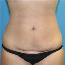 Tummy Tuck Before Photo by Joshua Cooper, MD; Seattle, WA - Case 49041