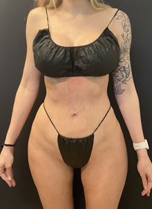 Buttock Lift with Augmentation After Photo by Johnny Franco, MD; ,  - Case 49055
