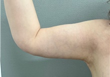 Arm Lift After Photo by Franklin Richards, MD; ,  - Case 49059