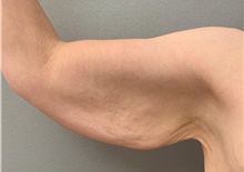 Arm Lift Before Photo by Franklin Richards, MD; ,  - Case 49059