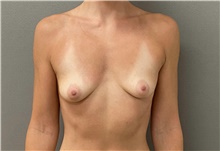 Breast Augmentation Before Photo by Keshav Magge, MD; Bethesda, MD - Case 49162