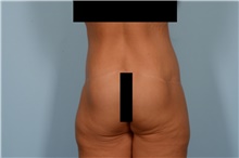 Body Lift After Photo by Ellen Janetzke, MD; ,  - Case 49278