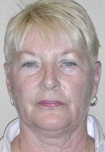 Dermal Fillers Before Photo by James Lowe, MD; ,  - Case 6769