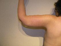 Arm Lift After Photo by Joseph Fodero, MD; Florham Park, NJ - Case 9087
