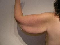 Arm Lift Before Photo by Joseph Fodero, MD; Florham Park, NJ - Case 9087