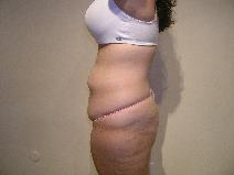 Body Contouring Before Photo by Joseph Fodero, MD; Florham Park, NJ - Case 9123